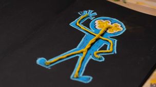 Osteogenesi imperfetta