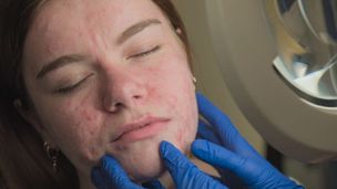 Acne sul viso