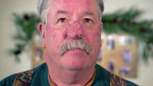 La rosacea