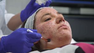 Acne e insicurezza